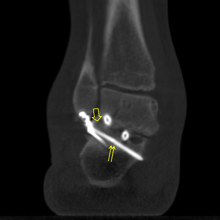 Case 1 AP and Oblique XRays